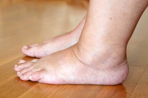 2-3-Oedema-management